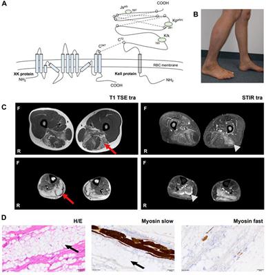 Case report: Clinical, genetic and immunological characterization of a novel XK variant in a patient with McLeod syndrome